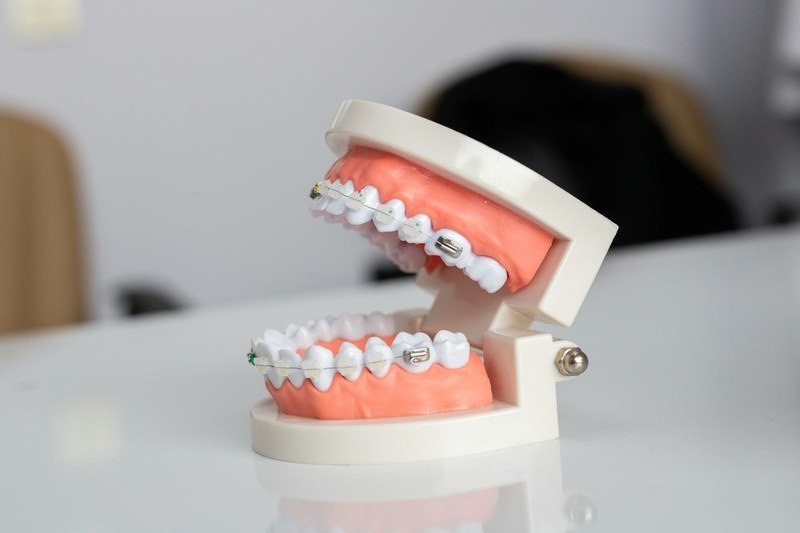 teeth model with braces